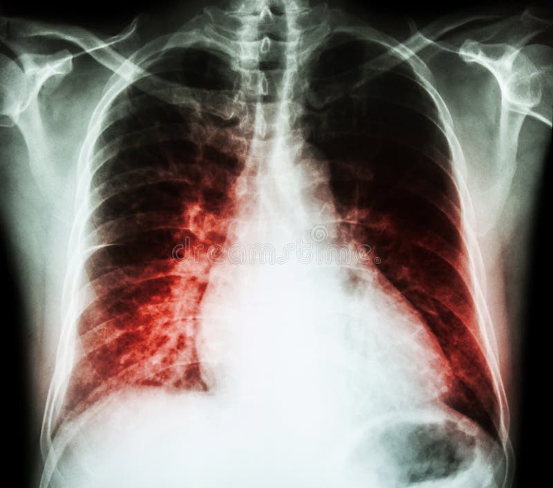 Niewydolność serca (ekranowy promieniowanie rentgenowskie klatki piersiowej PA pionowy: przedstawienia cardiomegaly i śródmiąższo