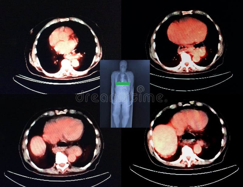 Pet/ct nuclear medicine very specific exam, radiopharmaceutical must be injected in right time during short time after production of isotope ,every slice is very important from scull to pelvis ,correct diagnose the most important result of this exam, red is level of exam pet/ct exam in medicine possible only in medical centers, which has ability to get nuclear medicine FDG18 radiopharmaceutical in time, due to very short time of 1/2 life of isotope , result of this exam images of every level of the body ,and for doctor one more chance make right conclusion. Pet/ct nuclear medicine very specific exam, radiopharmaceutical must be injected in right time during short time after production of isotope ,every slice is very important from scull to pelvis ,correct diagnose the most important result of this exam, red is level of exam pet/ct exam in medicine possible only in medical centers, which has ability to get nuclear medicine FDG18 radiopharmaceutical in time, due to very short time of 1/2 life of isotope , result of this exam images of every level of the body ,and for doctor one more chance make right conclusion