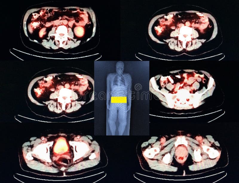 Pet/ct nuclear medicine very specific exam, radiopharmaceutical must be injected in right time during short time after production of isotope ,every slice is very important from scull to pelvis ,correct diagnose the most important result of this exam, yellow is level of exam pet/ct exam in medicine possible only in medical centers, which has ability to get nuclear medicine FDG18 radiopharmaceutical in time, due to very short time of 1/2 life of isotope , result of this exam images of every level of the body ,and for doctor one more chance make right conclusion. Pet/ct nuclear medicine very specific exam, radiopharmaceutical must be injected in right time during short time after production of isotope ,every slice is very important from scull to pelvis ,correct diagnose the most important result of this exam, yellow is level of exam pet/ct exam in medicine possible only in medical centers, which has ability to get nuclear medicine FDG18 radiopharmaceutical in time, due to very short time of 1/2 life of isotope , result of this exam images of every level of the body ,and for doctor one more chance make right conclusion