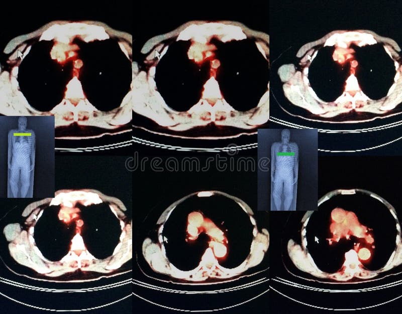 Pet/ct nuclear medicine very specific exam, radiopharmaceutical must be injected in right time during short time after production of isotope ,every slice is very important from scull to pelvis ,correct diagnose the most important result of this exam, red is level of exam pet/ct exam in medicine possible only in medical centers, which has ability to get nuclear medicine FDG18 radiopharmaceutical in time, due to very short time of 1/2 life of isotope , result of this exam images of every level of the body ,and for doctor one more chance make right conclusion. Pet/ct nuclear medicine very specific exam, radiopharmaceutical must be injected in right time during short time after production of isotope ,every slice is very important from scull to pelvis ,correct diagnose the most important result of this exam, red is level of exam pet/ct exam in medicine possible only in medical centers, which has ability to get nuclear medicine FDG18 radiopharmaceutical in time, due to very short time of 1/2 life of isotope , result of this exam images of every level of the body ,and for doctor one more chance make right conclusion