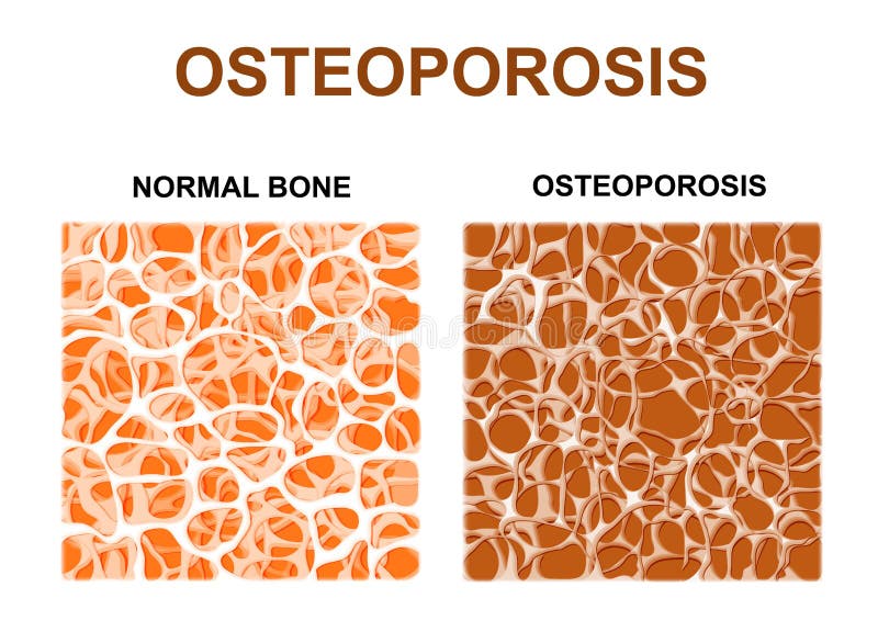 Normal bone and bone with osteoporosis