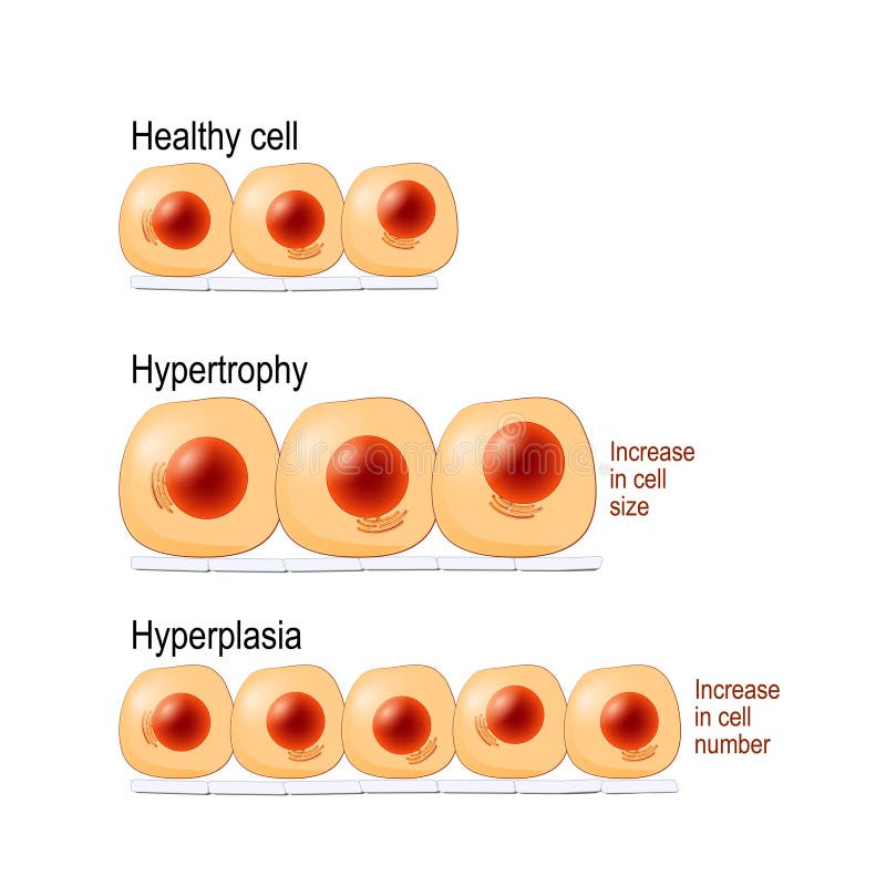 Normal celler, hypertrophy och hyperplasia stock illustrationer