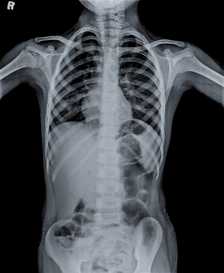 Normal Chest X Ray Of Human Child. Stock Image - Image of care