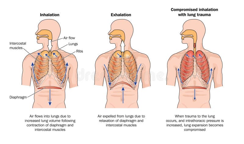 Drawing to show normal breathing (inhalation and exhalation), and the effects of lung trauma. Drawing to show normal breathing (inhalation and exhalation), and the effects of lung trauma