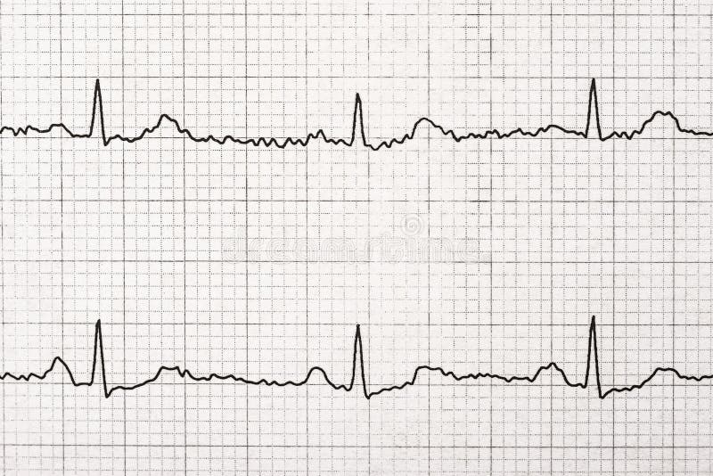 Normal Electrocardiogram Record On Paper Close Up. Normal Electrocardiogram Record On Paper Close Up