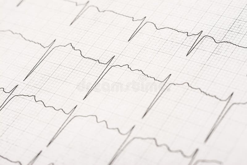 Normal Electrocardiogram Record Waves On Paper
