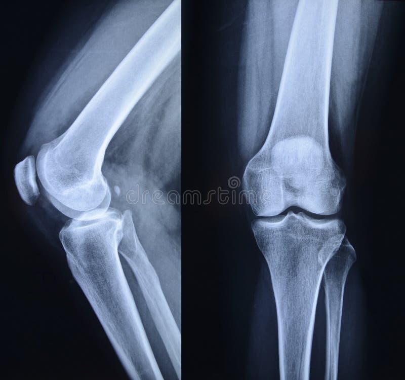 Normal Knee X Ray Anatomy