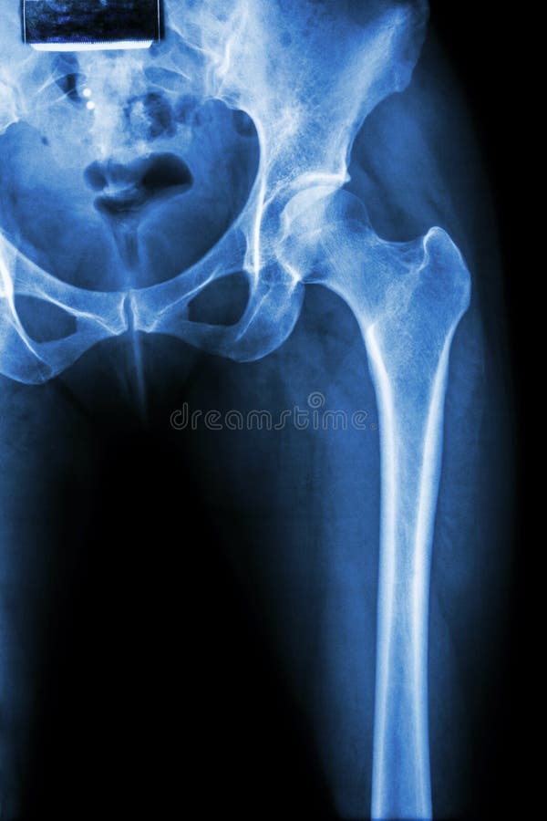 Normal pelvis & hip joint royalty free stock photography Normal pelvis & hip joint royalty free stock photography