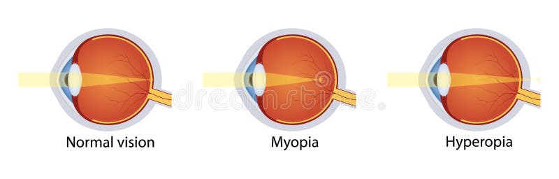 2 szem és látás myopia és hyperopia
