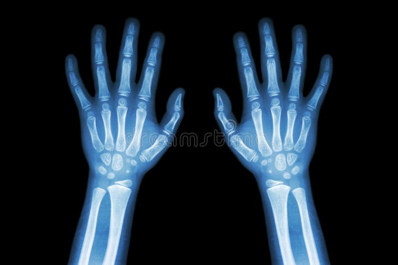 Normale dei raggi x del film entrambe le mani del bambino