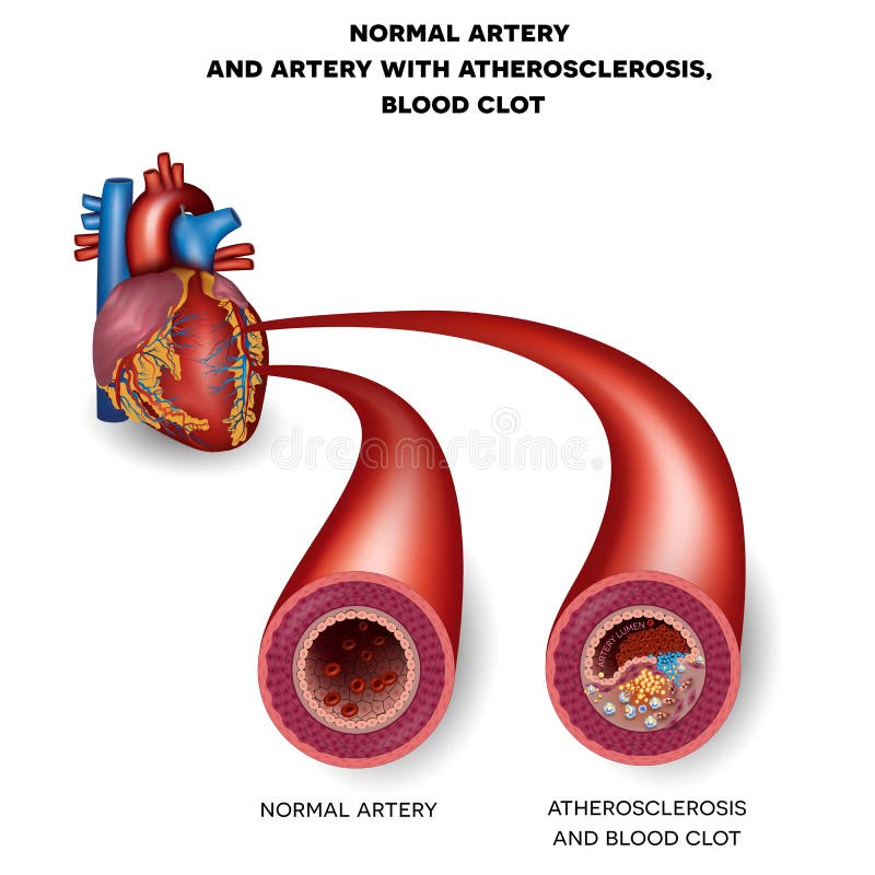 Normalna arteria i niezdrowa arteria