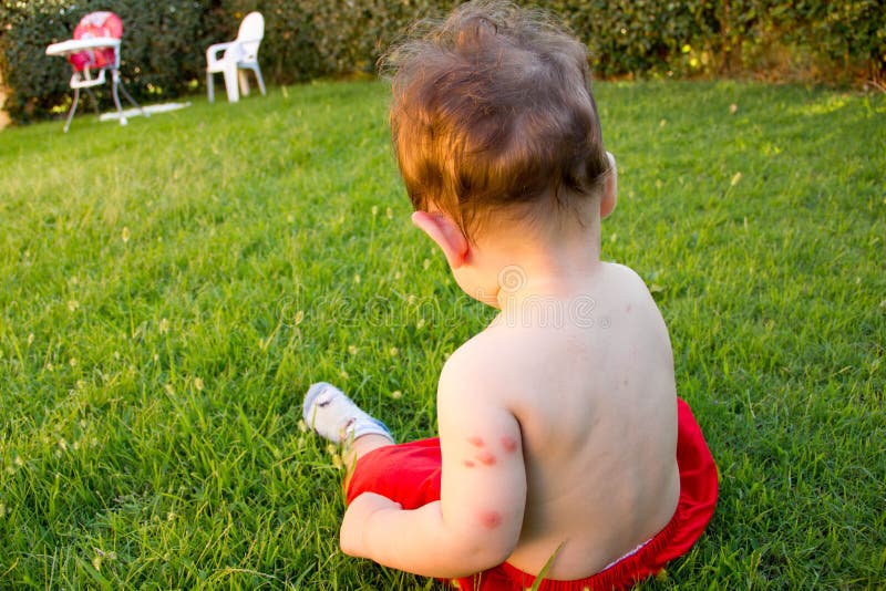 New born with multiple mosquito bites Allergy to insect bites. New born with multiple mosquito bites Allergy to insect bites