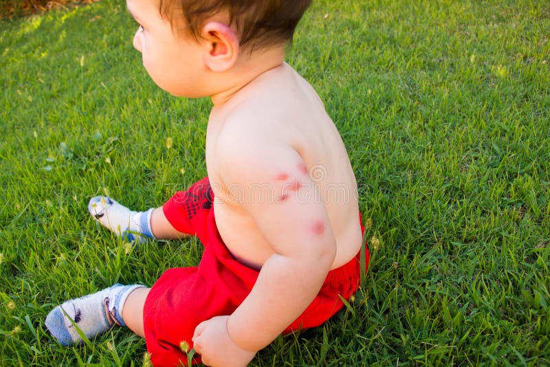 New born with multiple mosquito bites Allergy to insect bites. New born with multiple mosquito bites Allergy to insect bites