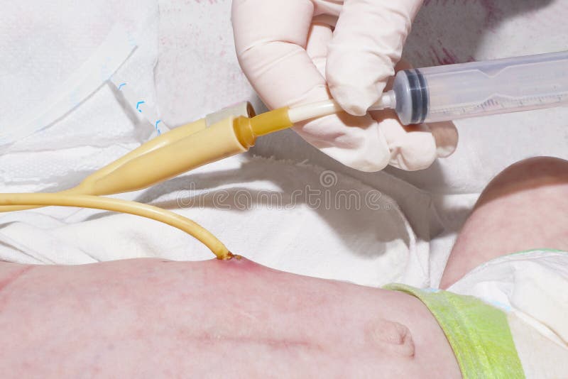 Nurse is feeding through g-tube after gastrostomy of newborn baby in neonatal intensive care unit at children`s hospital