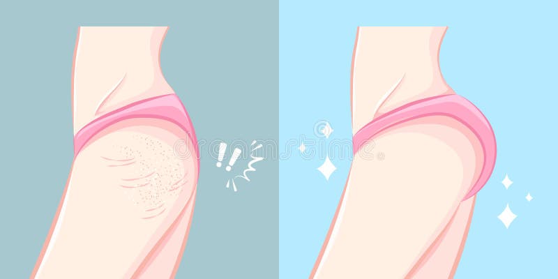 Nádegas com conceito da cirurgia plástica ilustração stock Nádegas com conceito da cirurgia plástica ilustração stock