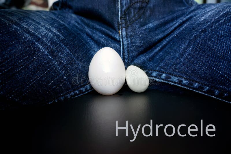 O conceito do hydrocele da doença fotografia de stock O conceito do hydrocele da doença fotografia de stock