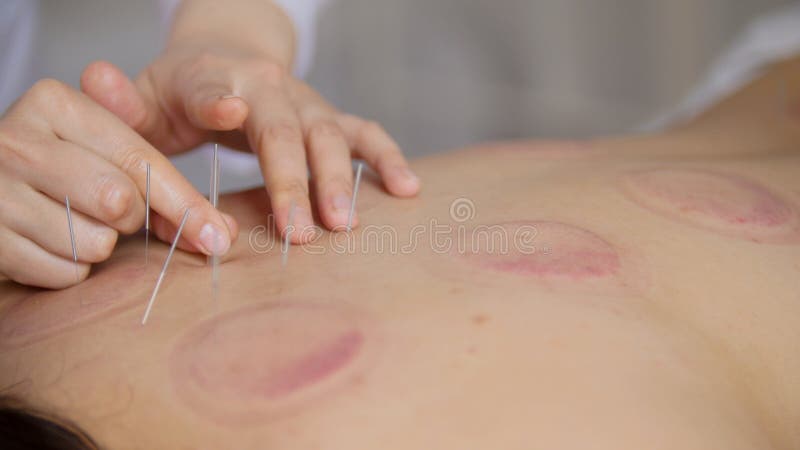 O doutor cola agulhas no corpo do ` s da mulher na acupuntura fotografia de stock O doutor cola agulhas no corpo do ` s da mulher na acupuntura fotografia de stock