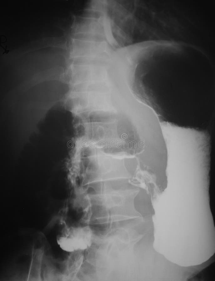 Obere gastro-intestinale (UGI) Studie eines 55-Jahr-alten Mannes, demonstrierte Postenleerdarmbehinderung der Kontrastmittel. lizenzfreie stockfotografie Obere gastro-intestinale (UGI) Studie eines 55-Jahr-alten Mannes, demonstrierte Postenleerdarmbehinderung der Kontrastmittel. lizenzfreie stockfotografie