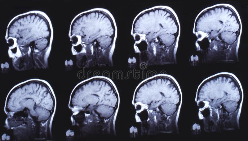 Picture of computed tomography of the brain. Black and white. Picture of computed tomography of the brain. Black and white.