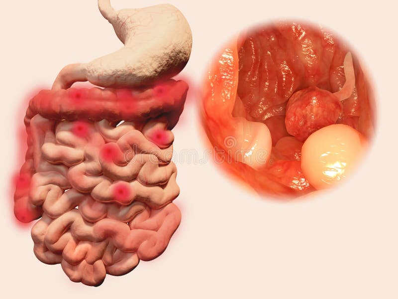 cancer colon maligne