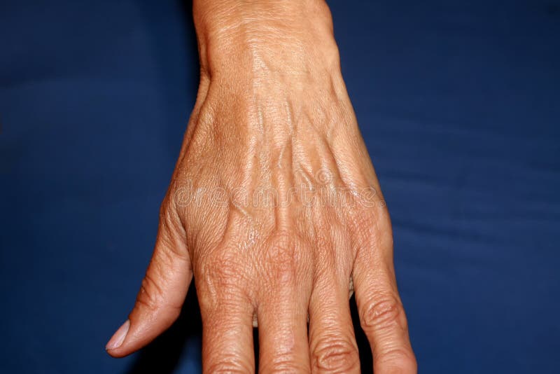 Veins Arm Stock Photos Download 770 Royalty Free Photos