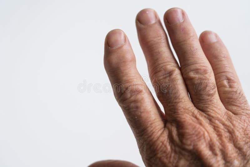 Old Mans Hand with Bent and Lumpy Finger Joints Stock Photo Image of body, white 210635740