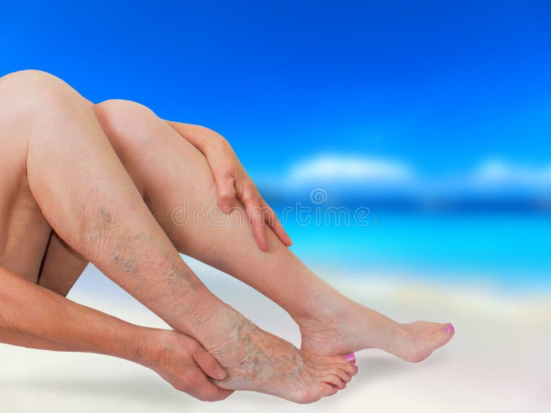 picioare varicose beach)