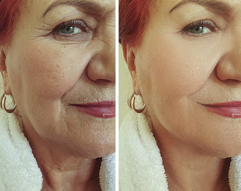 Old woman wrinkles face lift beautician before and effect correction after treatment