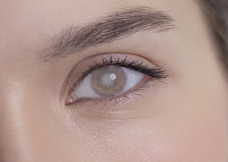 Oog van een vrouw met cataract royalty-vrije stock foto Oog van een vrouw met cataract royalty-vrije stock foto