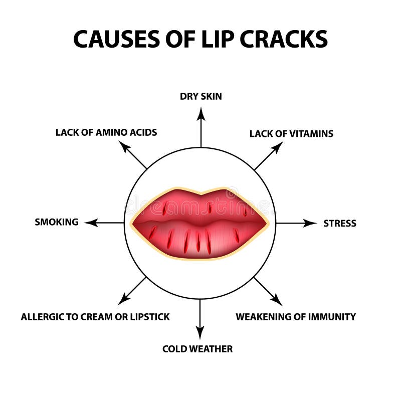 Oorzaken van lippenbarsten Barsten in de hoeken van de mond Infographics Vectorillustratie op geïsoleerde achtergrond royalty-vrije illustratie Oorzaken van lippenbarsten Barsten in de hoeken van de mond Infographics Vectorillustratie op geïsoleerde achtergrond royalty-vrije illustratie