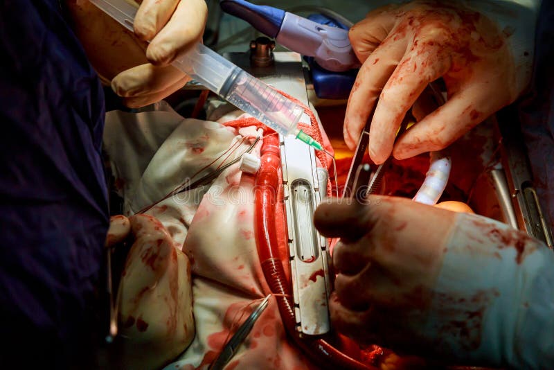Open Heart Surgery with Different Surgical Tools and Tubes Connected To ...