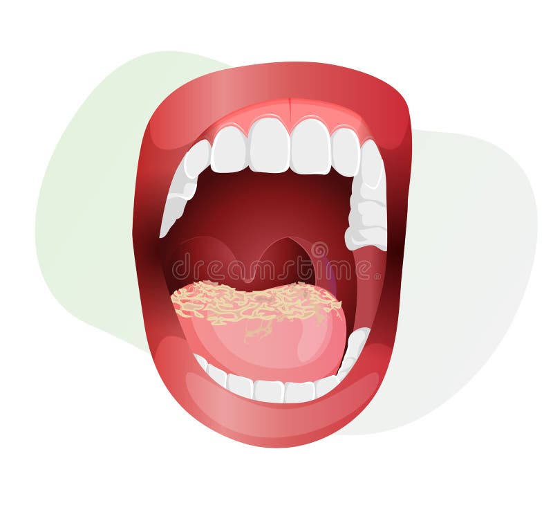 Open Mouth with Fungal Infection on Tongue - Stock Illustration Stock ...