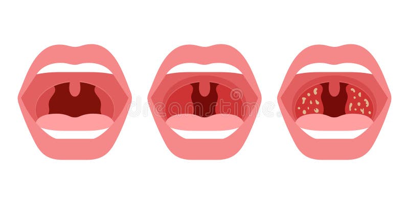 Open mouth with health and sick throat of human. Comparison healthy throat, tonsillitis bacterial and viral. Infection royalty free illustration