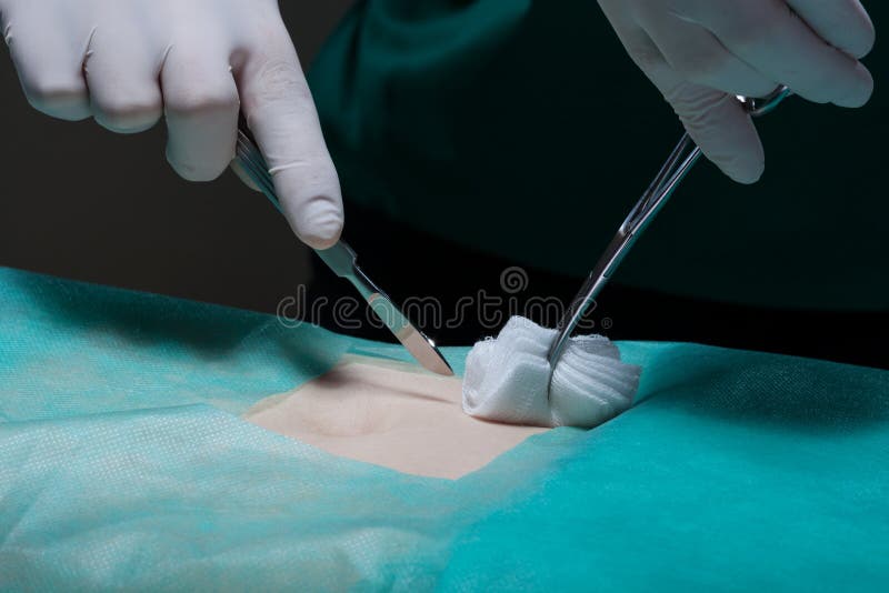 Navel Surgery stock image. Image of macro, closeup, carefully 74194059