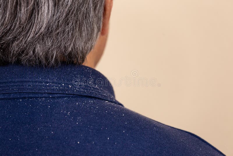 Opinión del primer un hombre que tiene mucha caspa de su pelo en su camisa y hombros fotografía de archivo libre de regalías Opinión del primer un hombre que tiene mucha caspa de su pelo en su camisa y hombros fotografía de archivo libre de regalías