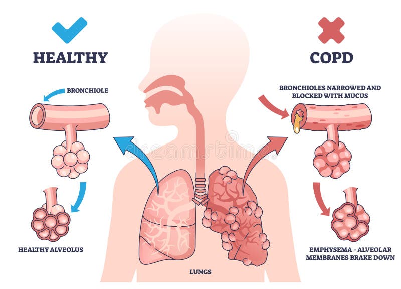 COPD or chronic obstructive pulmonary disease explanation outline diagram. Labeled educational medical scheme with healthy and respiratory illness lungs comparison vector illustration. Body diagnosis. COPD or chronic obstructive pulmonary disease explanation outline diagram. Labeled educational medical scheme with healthy and respiratory illness lungs comparison vector illustration. Body diagnosis