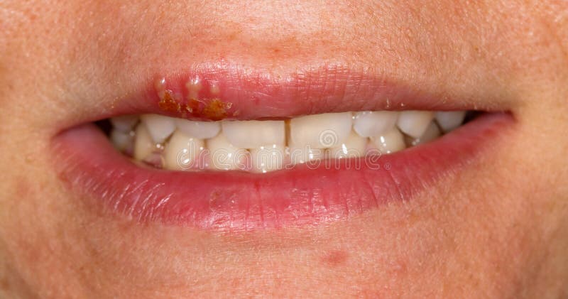 Labialis herpes Cold Sores: