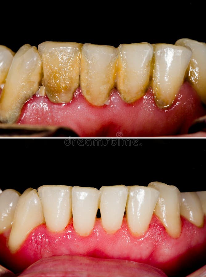 Before and after dental tartar removal - professional oral hygiene. Before and after dental tartar removal - professional oral hygiene.