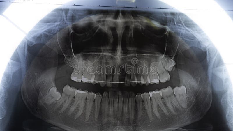 Original Black And White X Ray Teeth Scan Upper Teeth With Dental