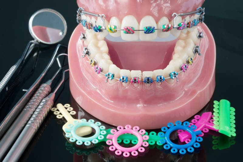 Orthodontic model. stock image. Image of closeup, device 116146913