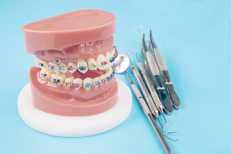 Orthodontic model. stock photo. Image of metal, denture 117535288