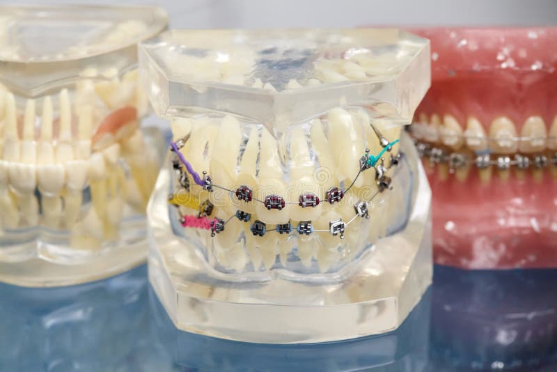 Orthodontic tand- modell för mänskliga tänder med implantat, tand- hänglsen royaltyfria bilder Orthodontic tand- modell för mänskliga tänder med implantat, tand- hänglsen royaltyfria bilder