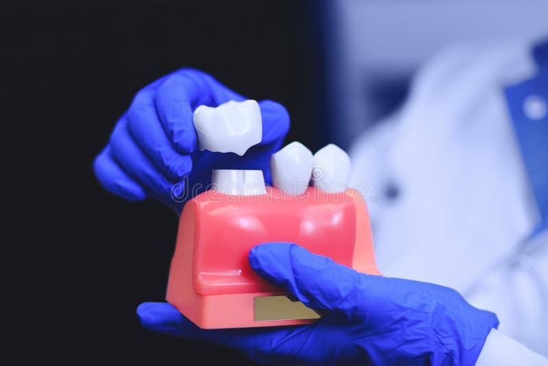 Orthodontic επεξεργασία με τα οδοντικά μοσχεύματα οδοντική στοματολογία ιατρικής μοσχευμάτων στοκ φωτογραφία με δικαίωμα ελεύθερης χρήσης Orthodontic επεξεργασία με τα οδοντικά μοσχεύματα οδοντική στοματολογία ιατρικής μοσχευμάτων στοκ φωτογραφία με δικαίωμα ελεύθερης χρήσης
