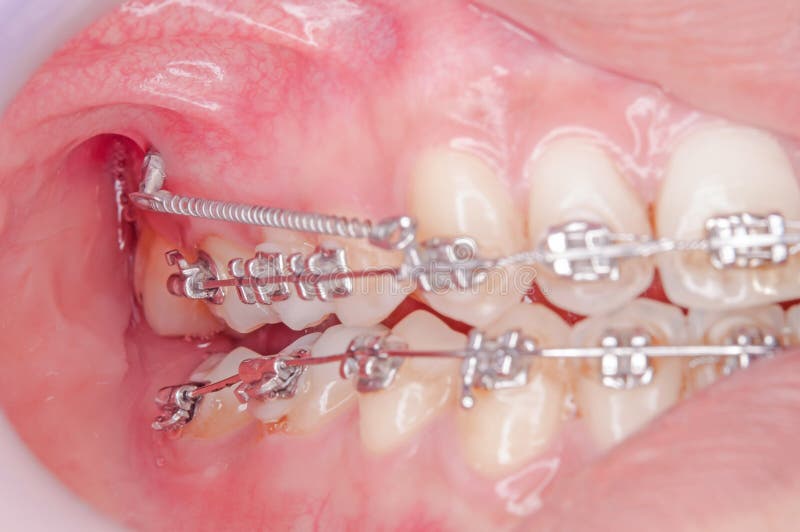 Orthodontics Procedure with Miniscrew. Stock Image Image of check