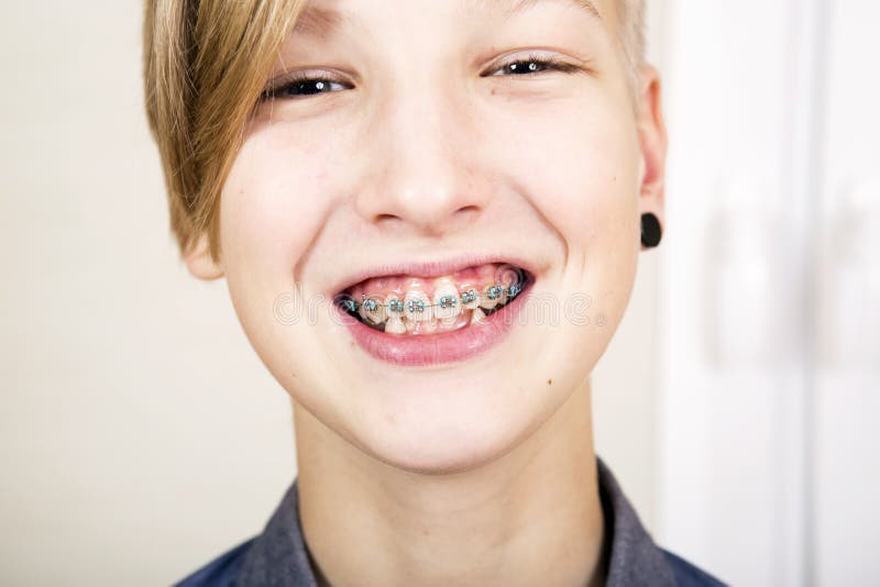 Teen with braces on his teeth. Orthodontics and bite correction. Teen with braces on his teeth. Orthodontics and bite correction.