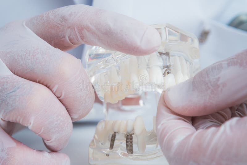 The Orthodontist Holds a Model of Teeth with Implants in His Hand and