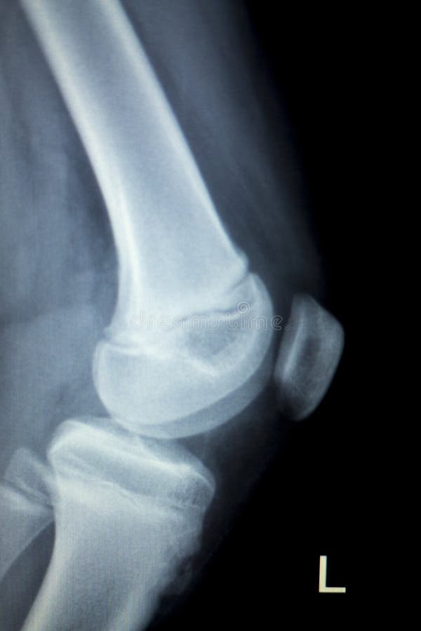 Orthopedics knee injury Xray scan.