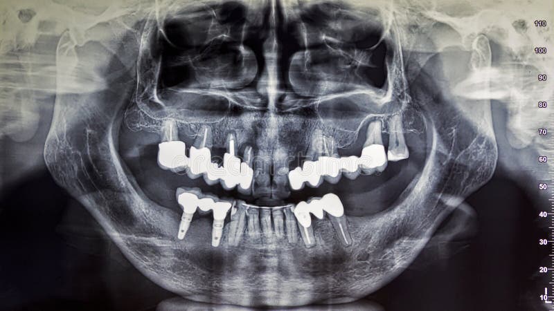 Página 53  Mandibula Raio X Imagens – Download Grátis no Freepik