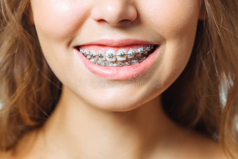 Ortodonti Begreppet tandvård Vackra Woman Healthy Smile nära Hackar av keramik och metall arkivfoto Ortodonti Begreppet tandvård Vackra Woman Healthy Smile nära Hackar av keramik och metall arkivfoto
