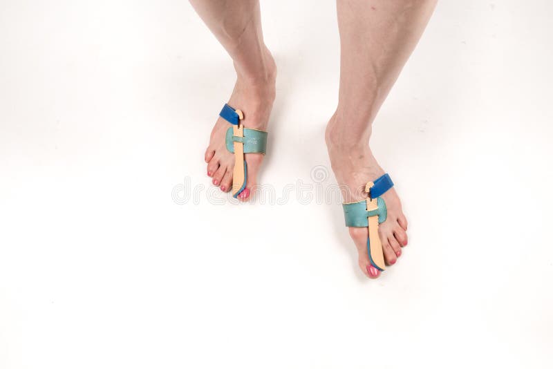 Ortose de estabilização para a correção do dedo grande do pé nos pés da mulher quando valgus do hallux, 2 pés, close-up isolados, foto de stock Ortose de estabilização para a correção do dedo grande do pé nos pés da mulher quando valgus do hallux, 2 pés, close-up isolados, foto de stock